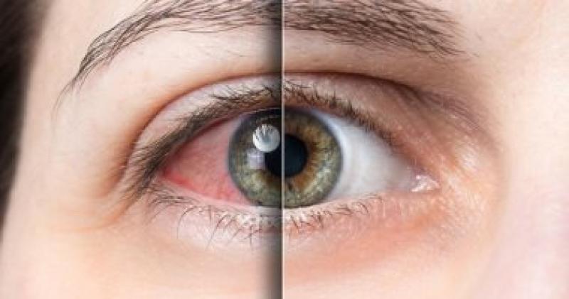 تعرف على ”متلازمة جفاف العين”.. الأسباب وطرق العلاج