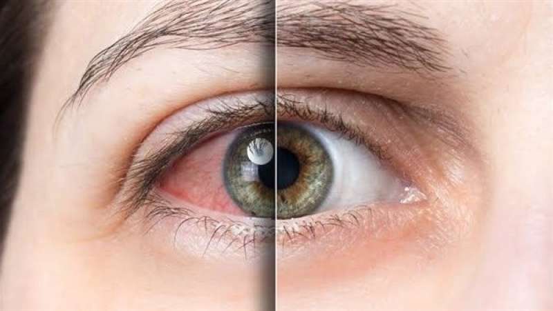 نصائح تساعد في حل مشكلة جفاف العين المزمنة والمزعجة