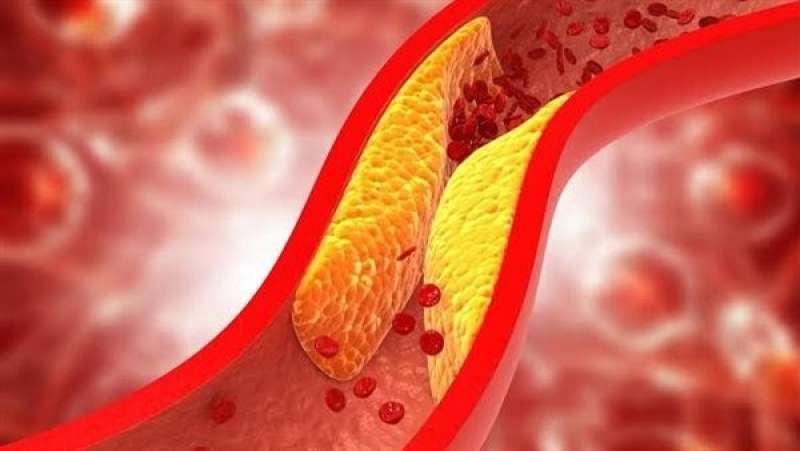 مضاعفات ارتفاع الكوليسترول في الدم